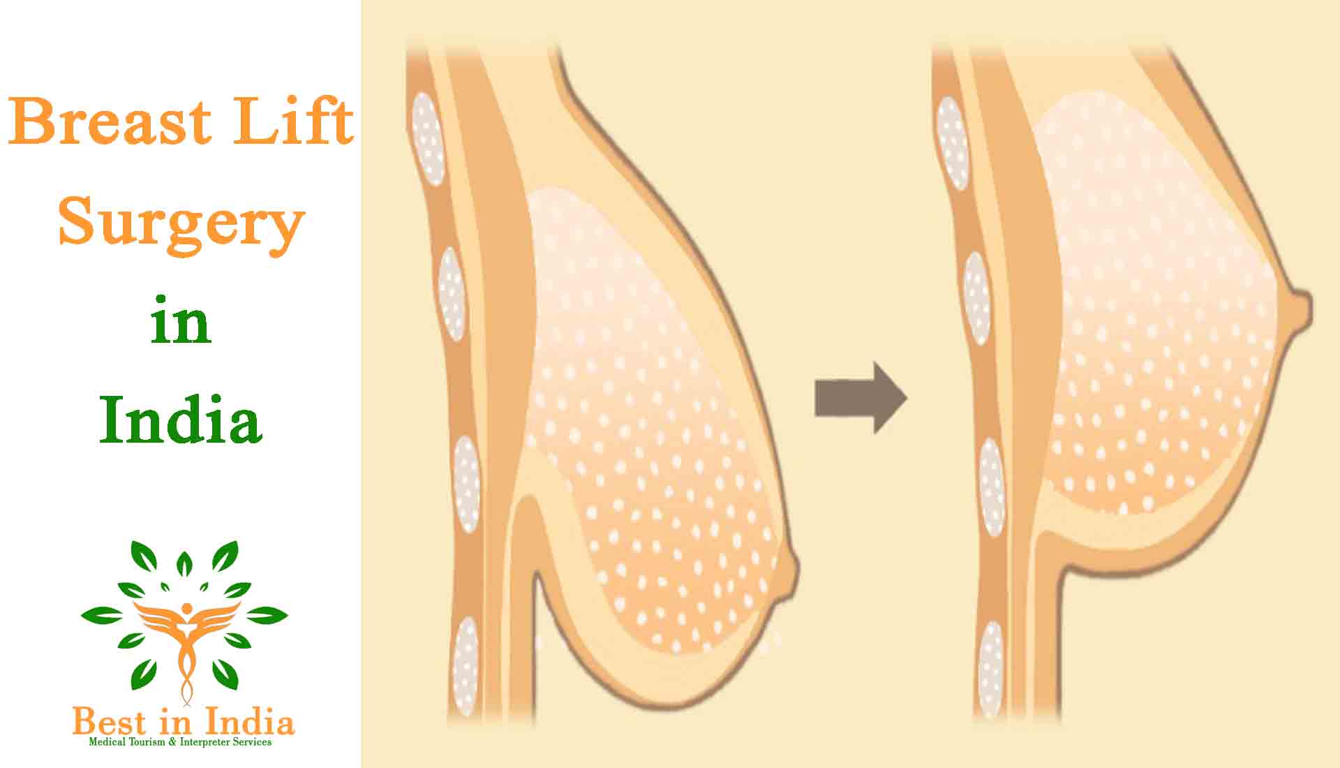 Breast lift surgery at low cost in India