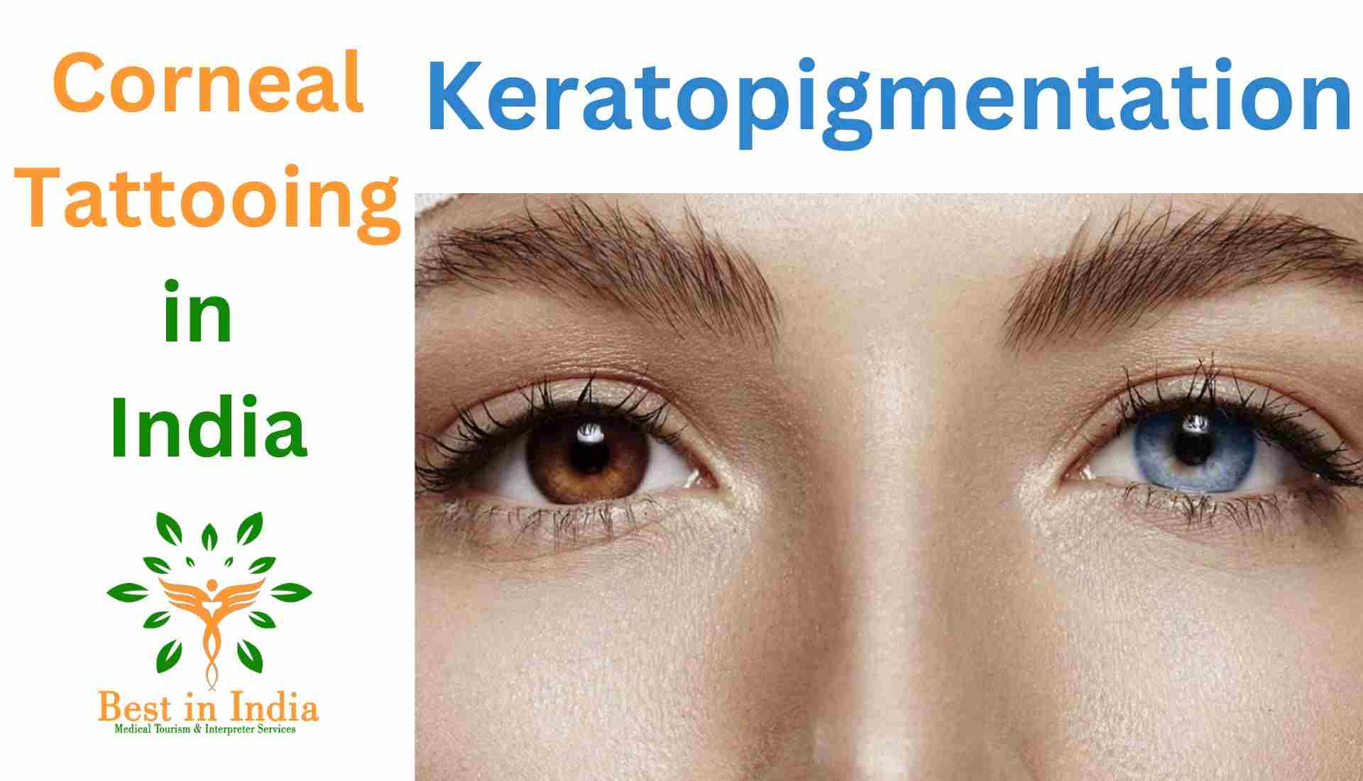 Keratopigmentation or Corneal Tattoo: Eye Color Change Surgery in India