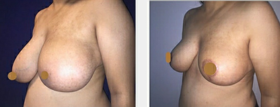 Beast lift, breast surgery, breast augmentation, breast reduction, breast lift home, Breast lift surgeon, Breast reduction surgeon, Breast lift clinic, breast implant surgery, Breast implant surgeon, Breast implant clinic,
