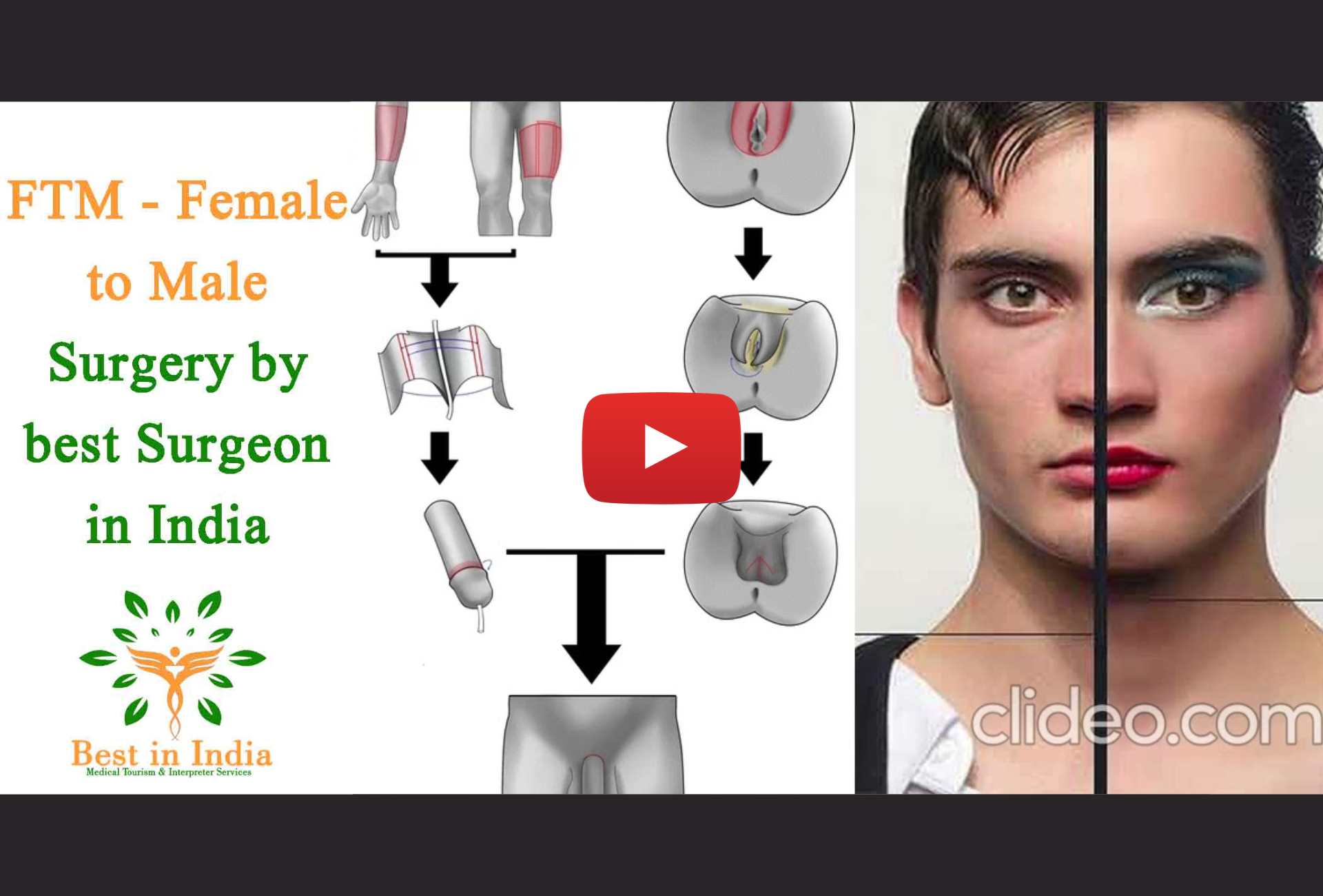 Female to Male Surgery Podcast on Youtube