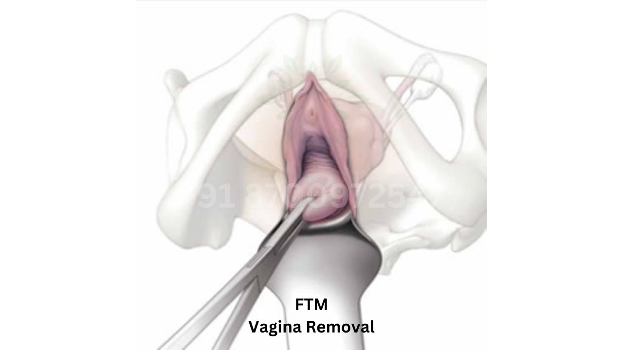Vagina Removal or Vaginectomy ) or Uterus removal ( Hysterectomy ) for Female to Male surgery 